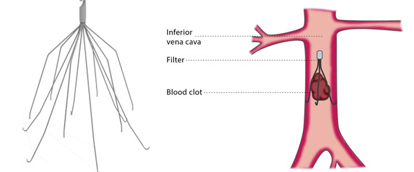 IVC Filter Lawsuit | Elk & Elk Ohio